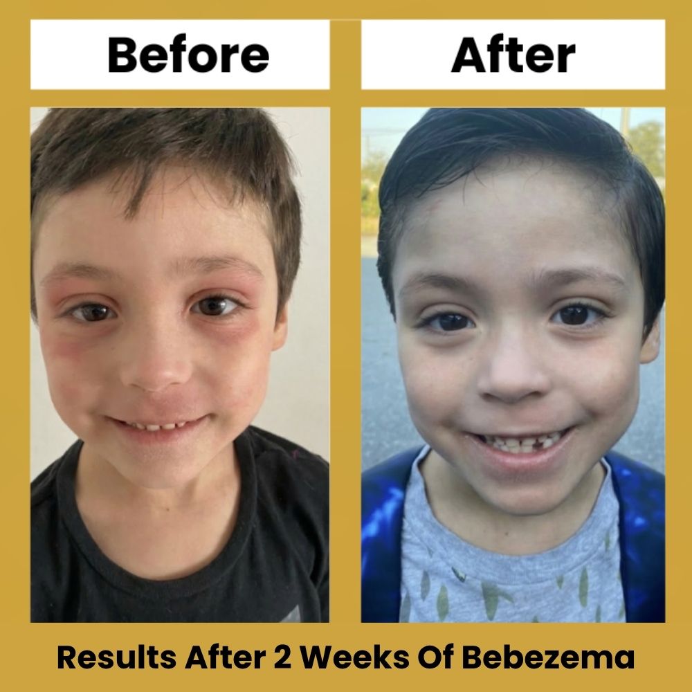 Bebezema Honey Eczema Soothing Cream