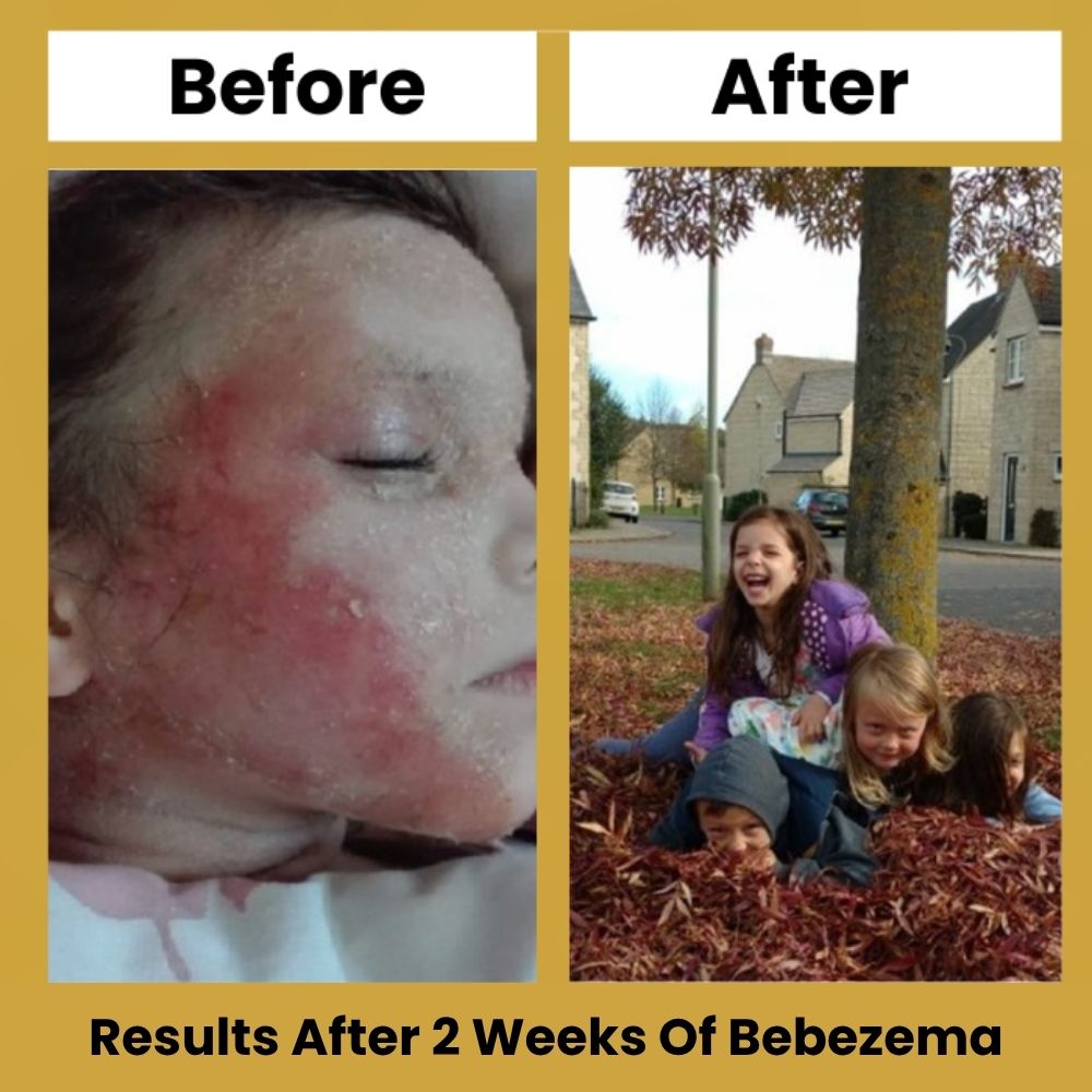 Bebezema Honey Eczema Soothing Cream